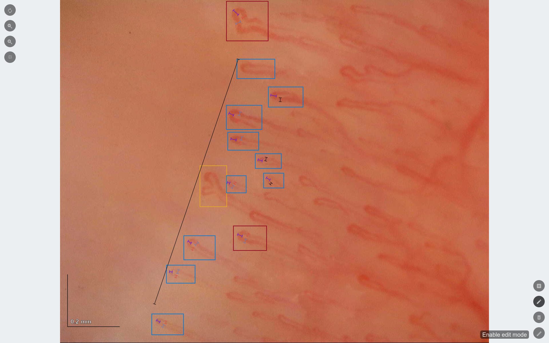 Detección automática de capilares y hemorragias en Capillary.io